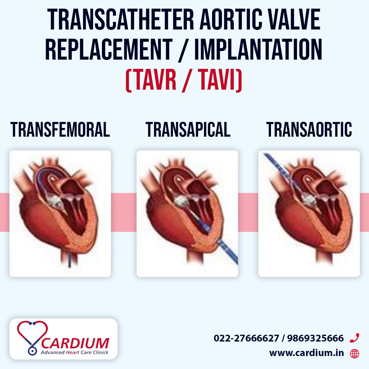 Dr Rahul Gupta – Complex Angioplasty & Valve Expert